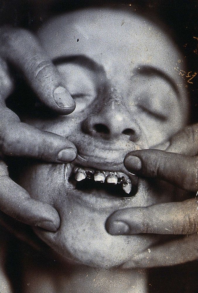 Friern Hospital, London: a young child with rotten teeth. Photograph, 1890/1910.