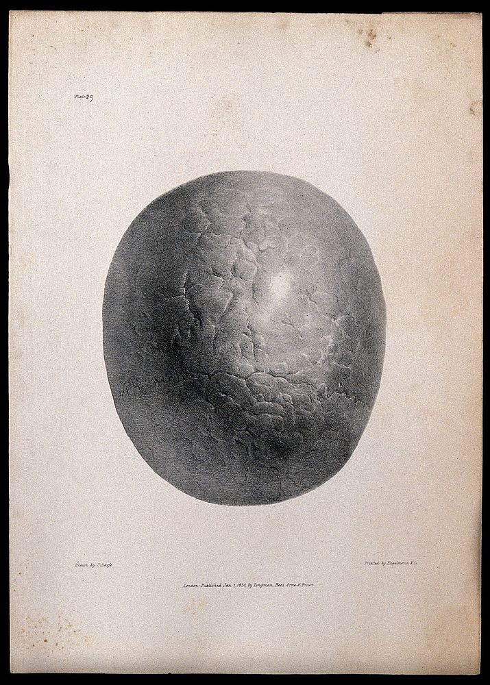 The skull of an epileptic as viewed from above. Lithograph after G. Scharf for Richard Bright, 1830.