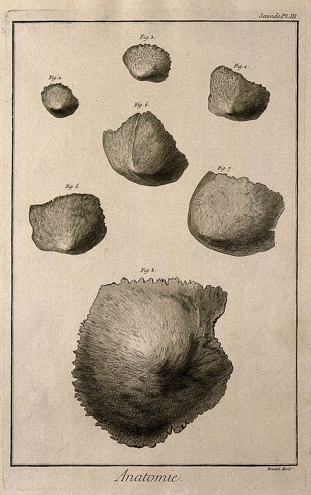 Different degrees of ossification of the parietal bone of the skull. Engraving by Benard, late 18th century.