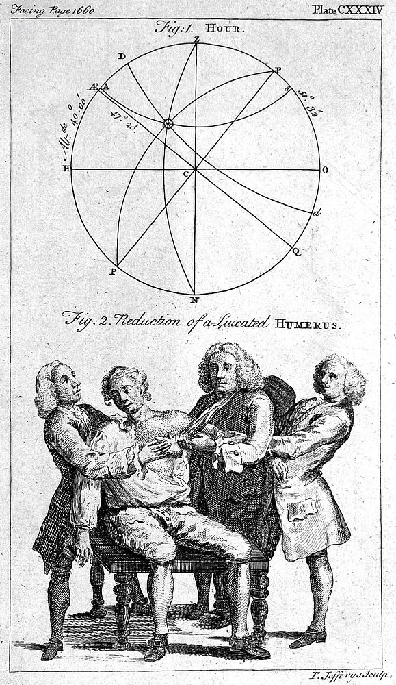 A surgeon and two assistants manipulating a dislocated shoulder joint back into the correct position. Etching by T. Jefferys.