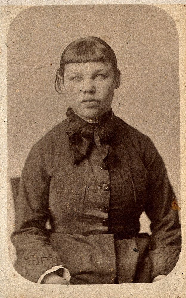 A young woman with a short fringe, showing signs of mental deficiency. Photograph by J. Davis.