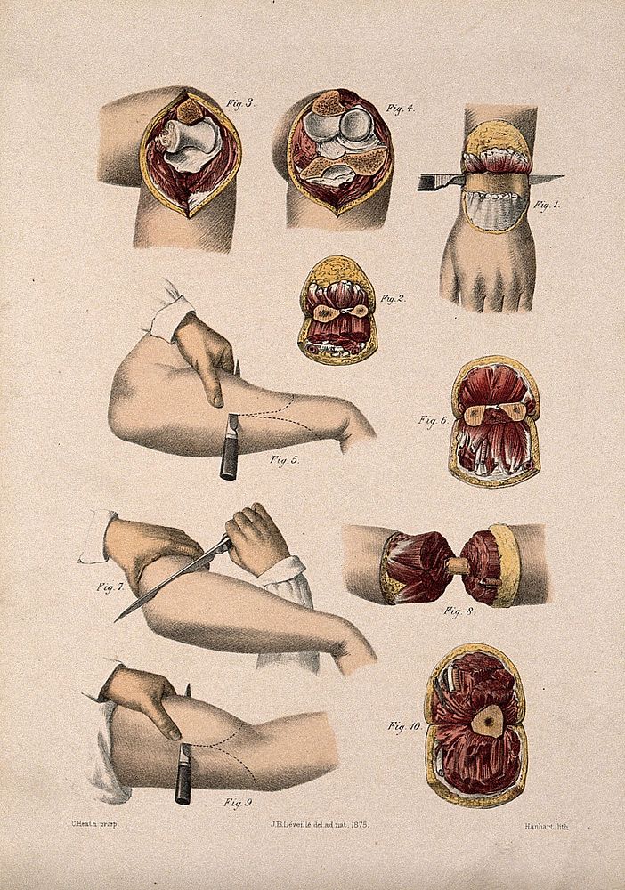 Cross-sections of the arm and wrist. Coloured lithograph by M. Hanhart after C. Heath after J.B. Léveillé.