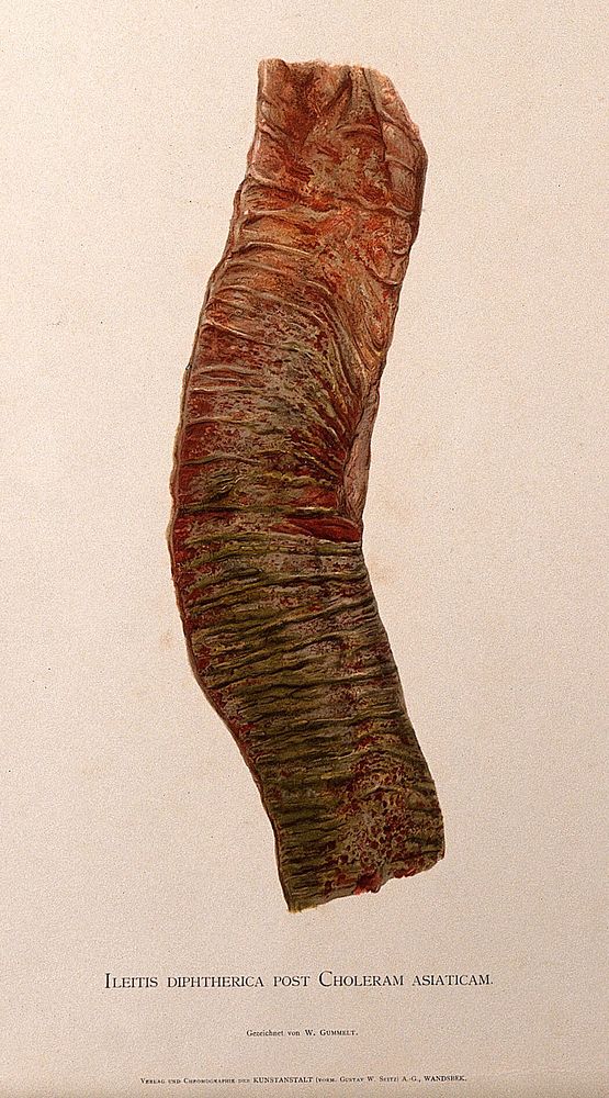 Part of the intestine showing signs of ileitis diphtherica following cholera asiatica. Chromolithograph by W. Gummelt, ca.…