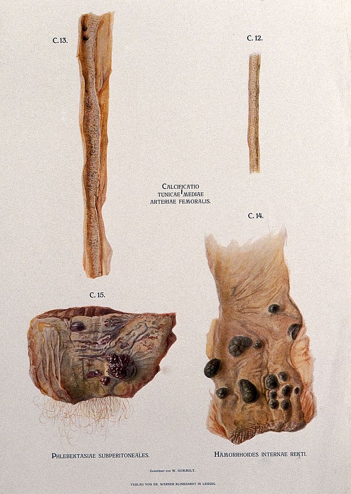 Dissections of femoral arteries affected by calcification, with illustrations of subperitoneal phlebectasia and rectal…