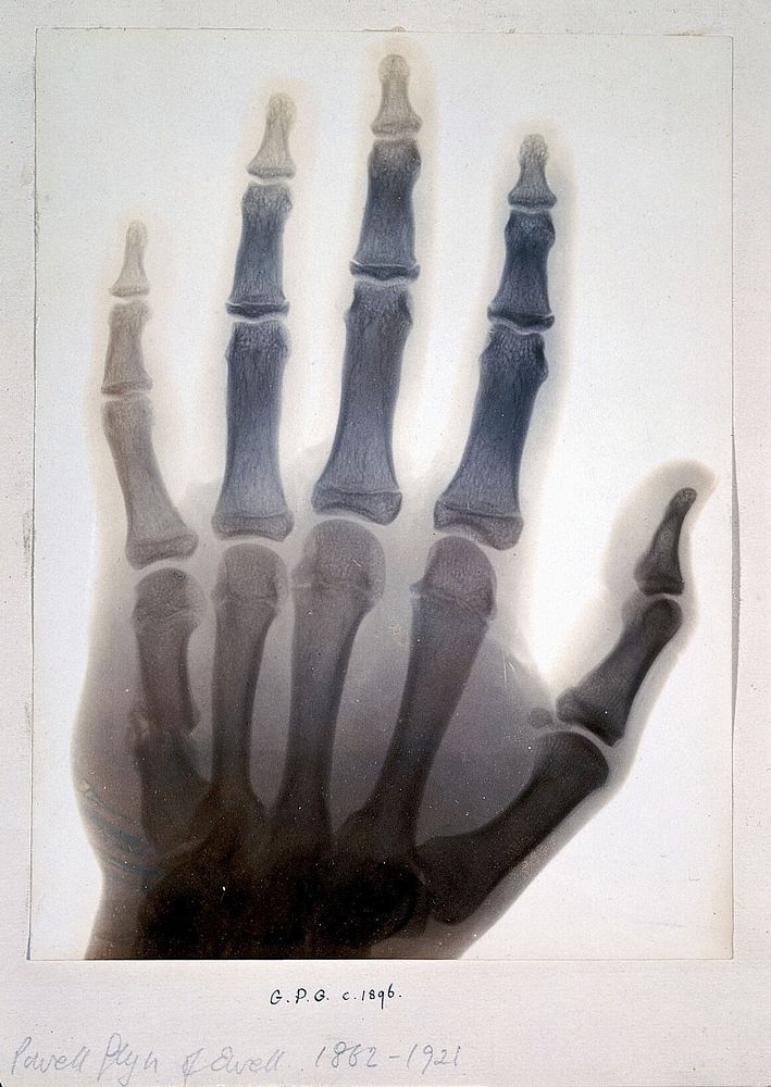 Sir Gervas Powell Glyn, 6th Bart.: radiograph of his hand. Photograph by Sir G.P. Glyn, 1896.