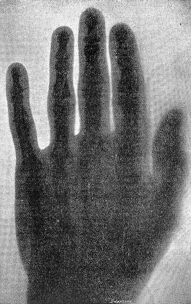 X-ray picture of hand by A.A.C. Swinton, 1896.