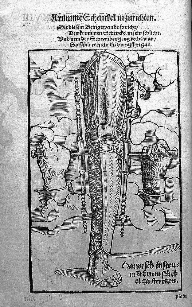 Gersdorff, Feldtbuch der Wundartzney, 1527