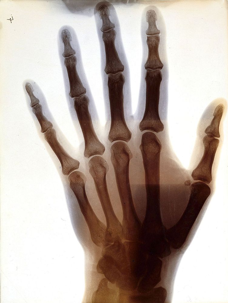 Hand of M.H. G[lyn]: radiograph. Photograph by Sir G.P. Glyn, ca. 1896.