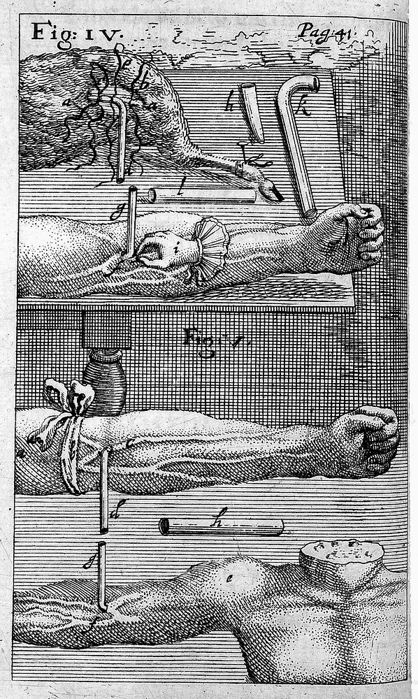 Engravings of techniques of blood transfusion from man to animal.