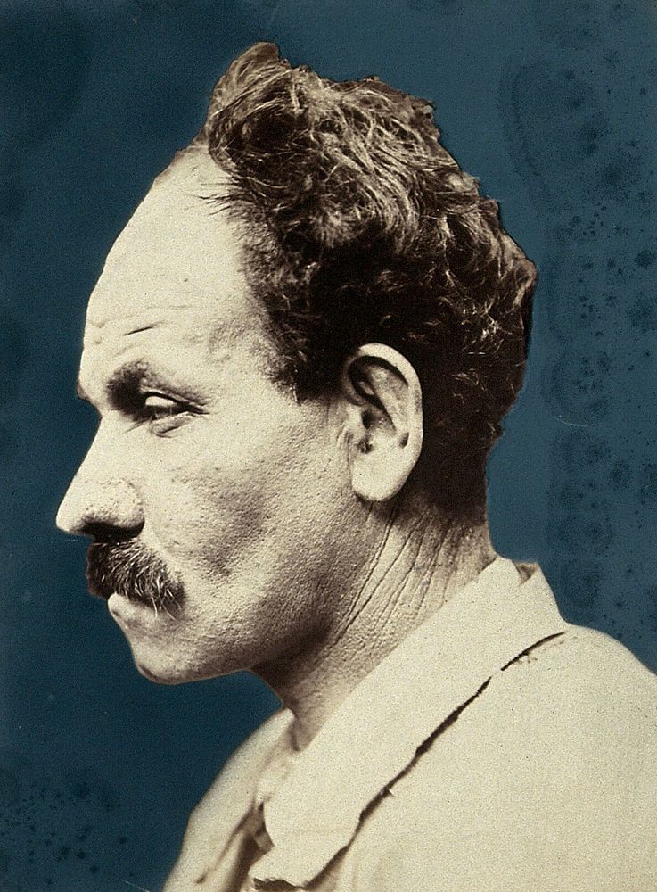 A man following plastic surgery to his nose, damaged by hypertrophic acne, in profile. Photograph by Félix Méheux, ca. 1900.