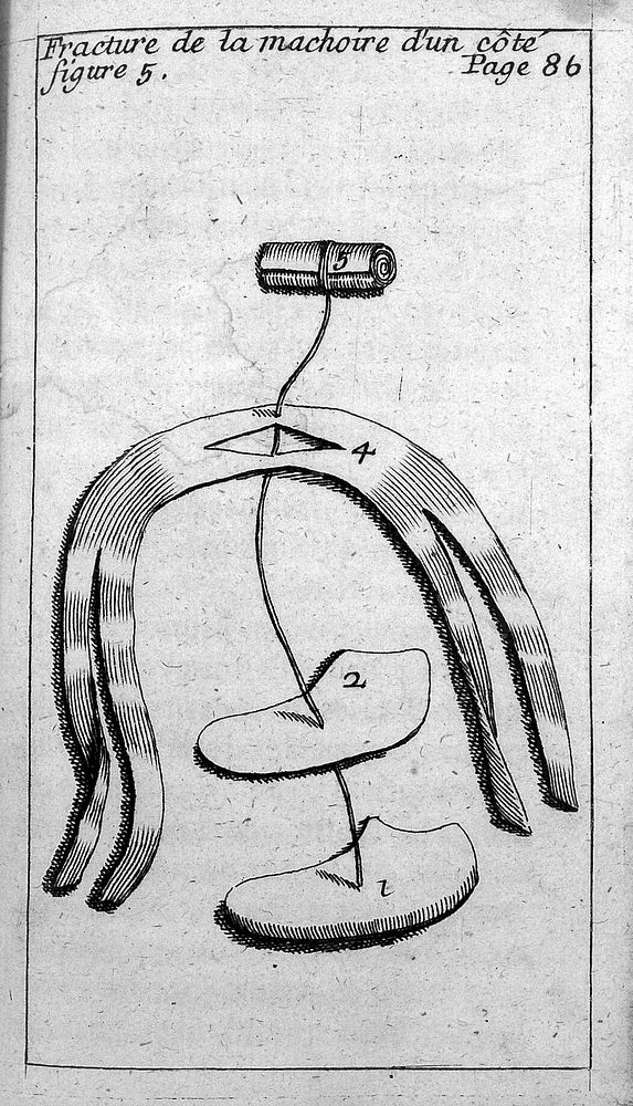 Fracture de la machoire d'un cote, from Le Clerc, L'appareil commode en faveur des jeunes chirurgiens, 1700