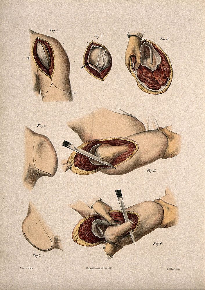 Excision of the shoulder joint  Coloured lithograph by M. Hanhart after C. Heath after J.B. Léveillé.