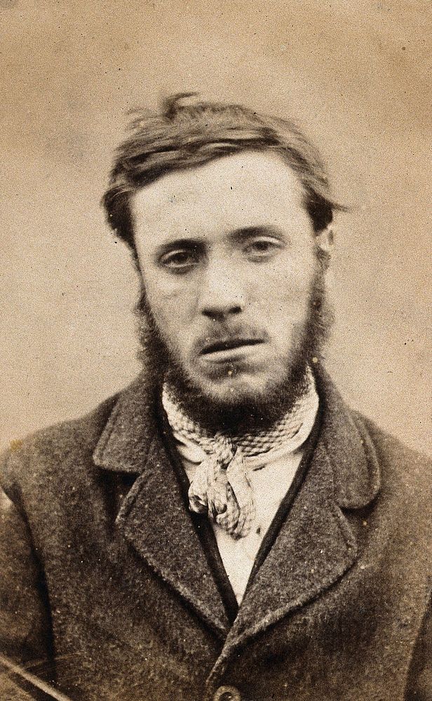John Edward Gartside, a patient at the West Riding Lunatic Asylum, Wakefield, Yorkshire. Photograph attributed to James…