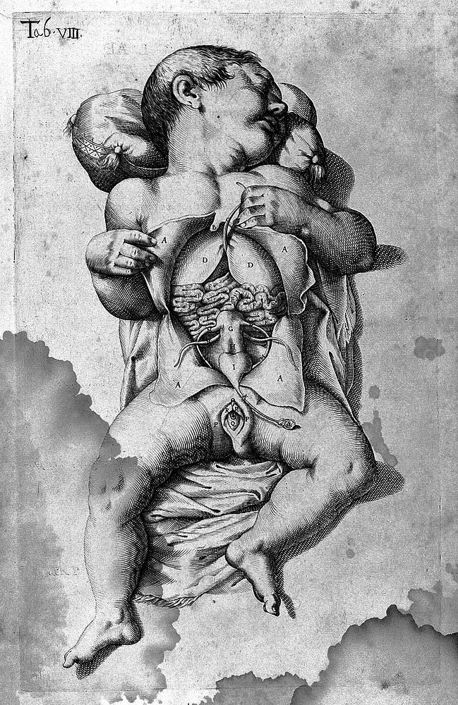 De formato foetu liber singularis aeneis figuris exornatus. Epistolae duae anatomicae. Tractatus de arthritide / Opera…
