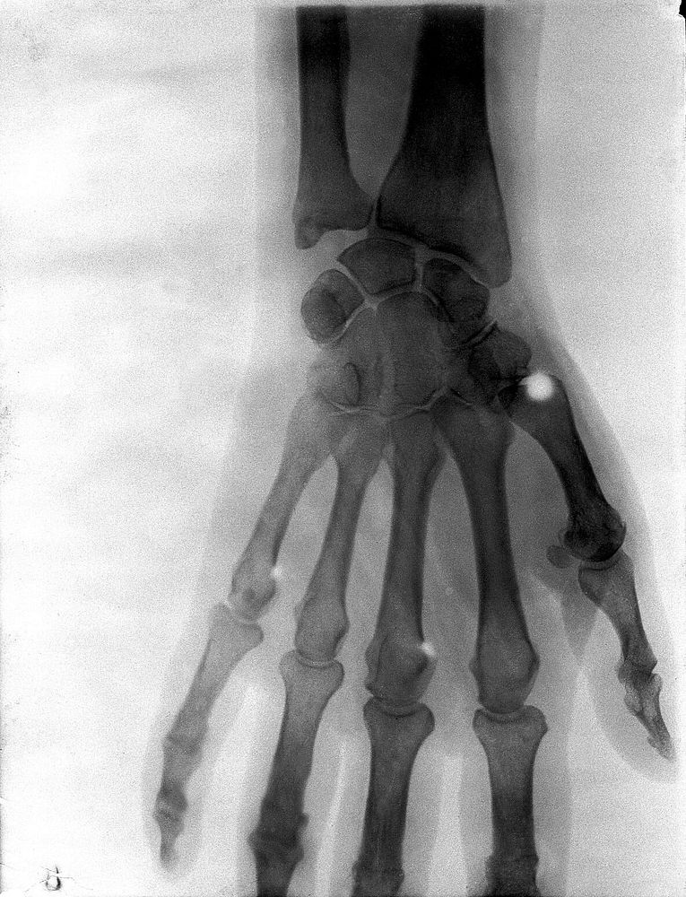 Bones of the hand of W. Scott-Moncrieff, showing the effect of a bullet-wound. Radiograph, 1900/1904.