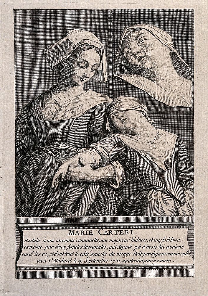 Marie Carteri, a girl suffering from growths in her lacrimal glands as well as many aches and pains. Engraving.