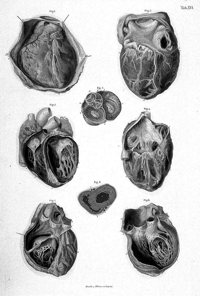 The heart, it's cavities and valves. Fig. 1 - Anterior surface of Heart and Pericardial covering., Fig. 2 - Posterior…