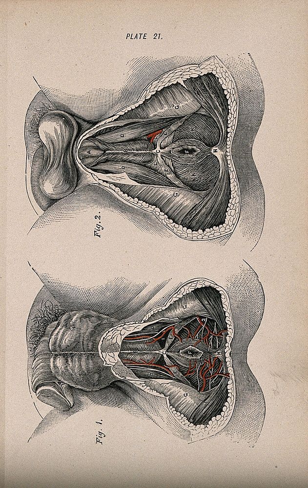 Dissections of the male genital and rectal area: two figures. Colour wood engraving with letterpress, 1860/1900.