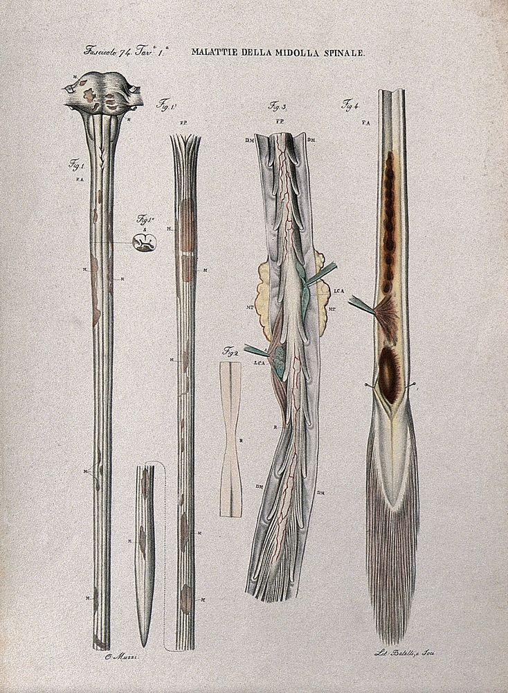 Several sections of diseased spinal cord, numbered for key. Coloured lithograph by Batelli after Ottavio Muzzi, c. 1843.