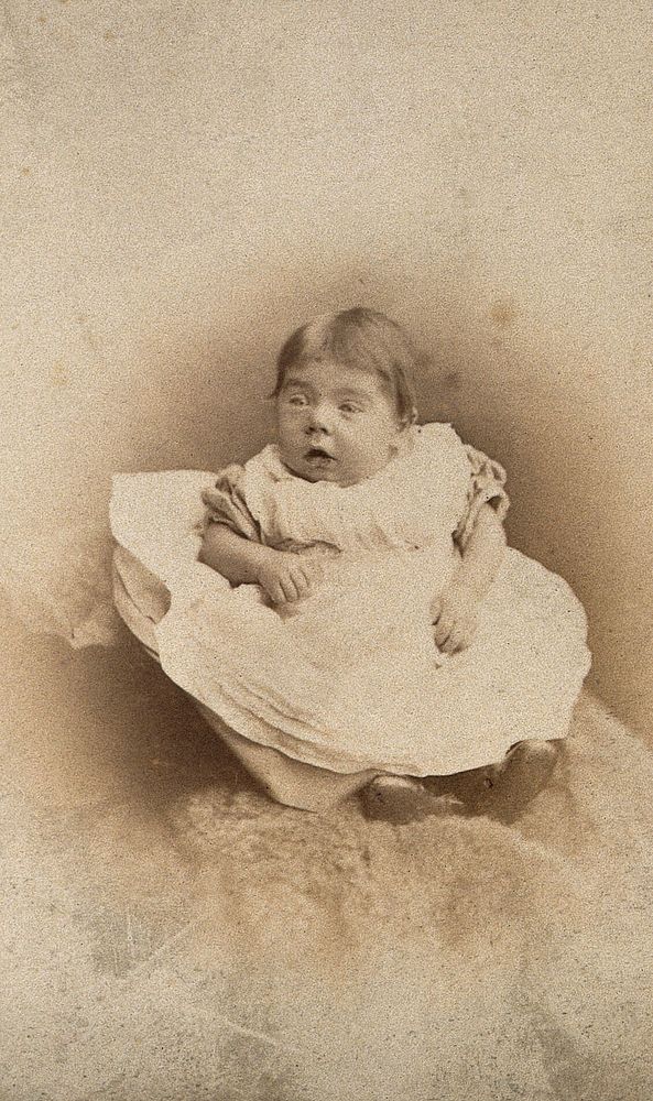 A child showing signs of Down's syndrome sitting on a fur cushion. Photograph by J.H. Hogg.