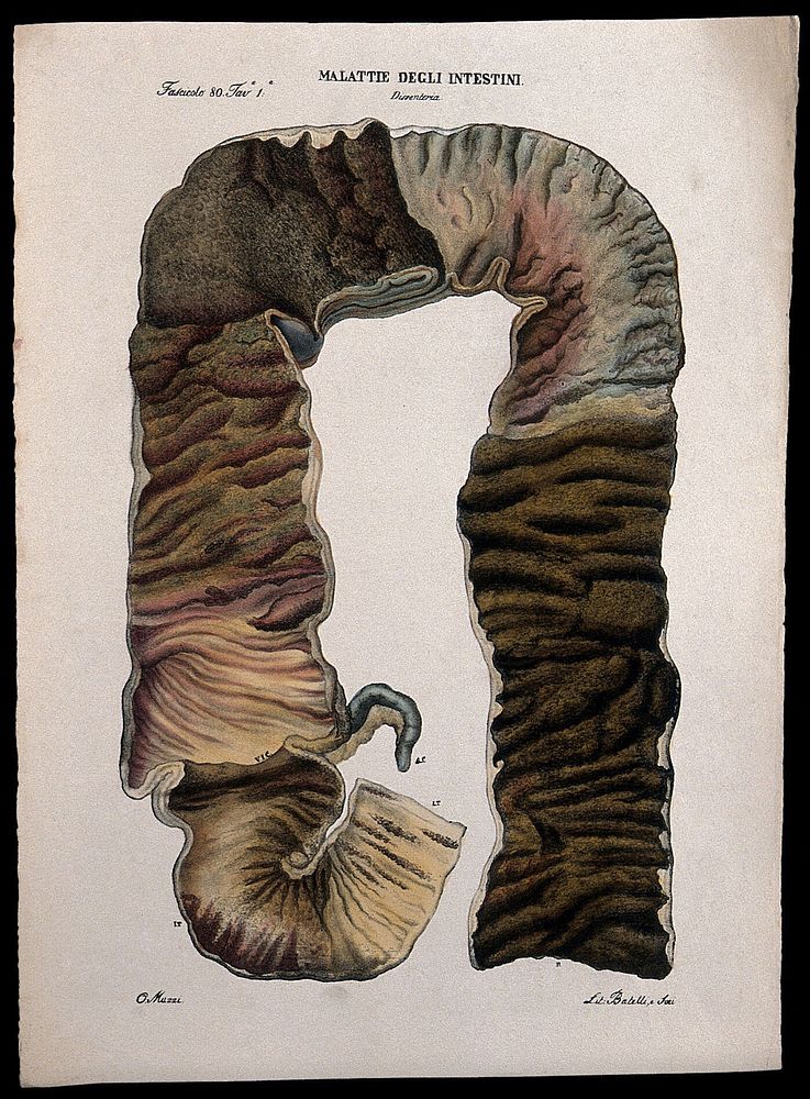 A cross-section of diseased intestines (dysentery). Coloured lithograph by V. Batelli after O. Muzzi, c. 1843.