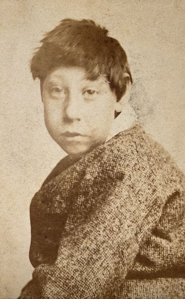 A young dark-haired boy, showing signs of mental deficiency, wearing a tweed coat, looking at the camera from over his left…