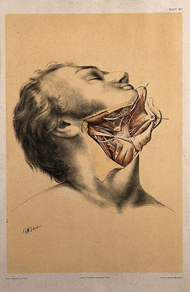Dissection of the side of the jaw and neck, with the muscles and blood vessels indicated. Colour lithograph by G.H. Ford…