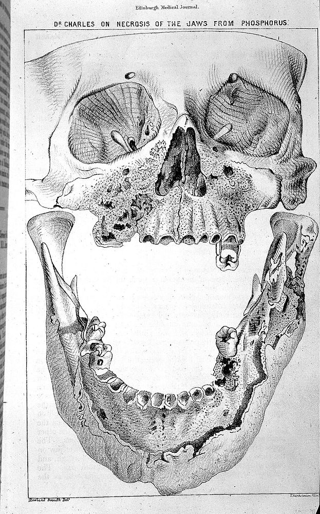 Skull with jaw affected by phosphorus poisoning.