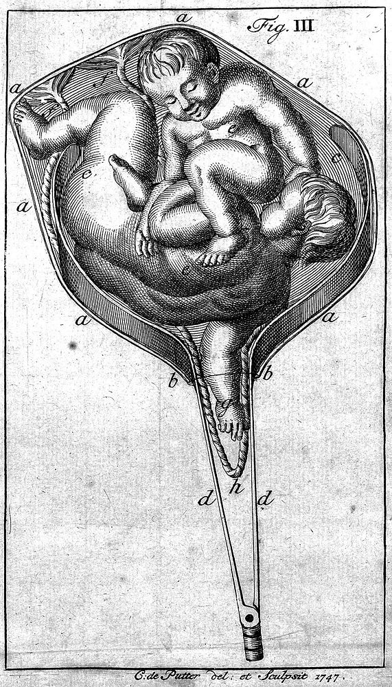 Embryulcia nova detecta, of eene heel nieuw en onbekende ... behandelinge, in de meeste moeielyke baaringen, op ... te…