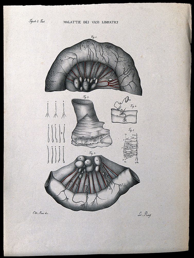 Several sections of diseased lymph vessels, numbered for key. Coloured lithograph by Ridolfi after Ottavio Muzzi, c. 1843.