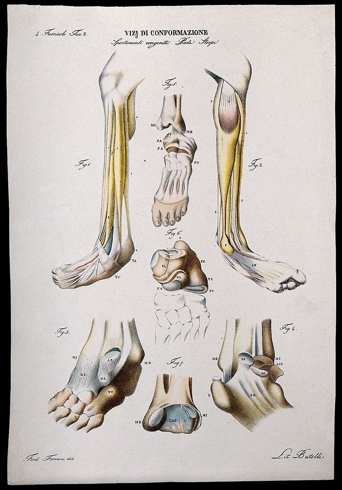 Examples of foot deformities: skeletal detail, numbered for key. Lithograph by Batelli after Ferdinando Ferrari, c. 1843.