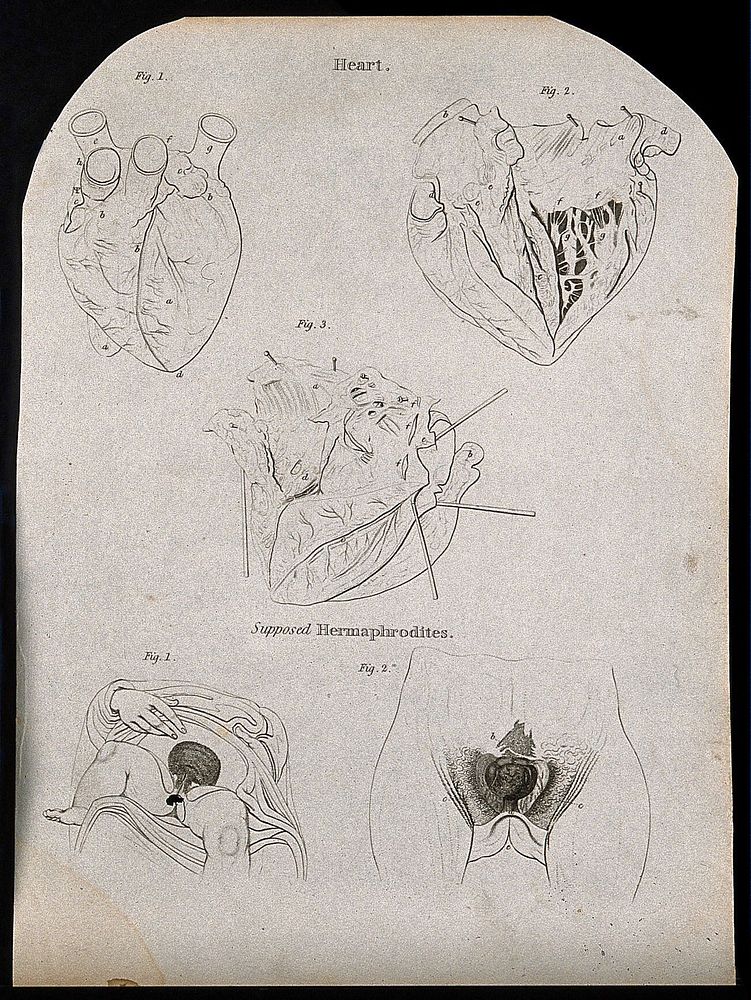 Heart: three figures, and the genital area of supposed intersex people: two figures. Line engraving by Campbell, 1816/1821.