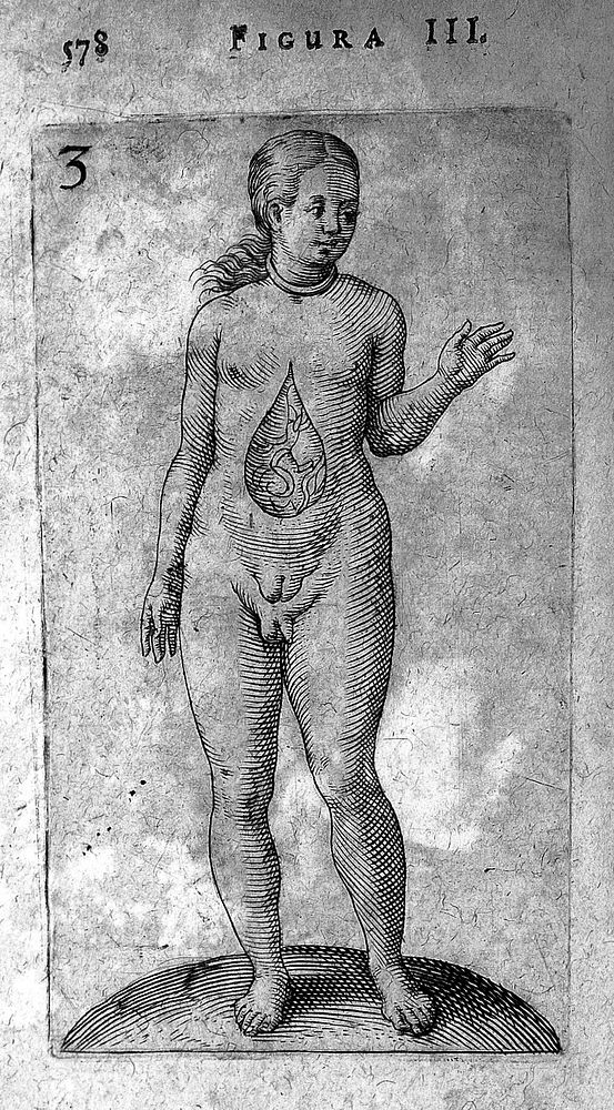 Hermaphrodite from De Hermaphroditorum, 1614
