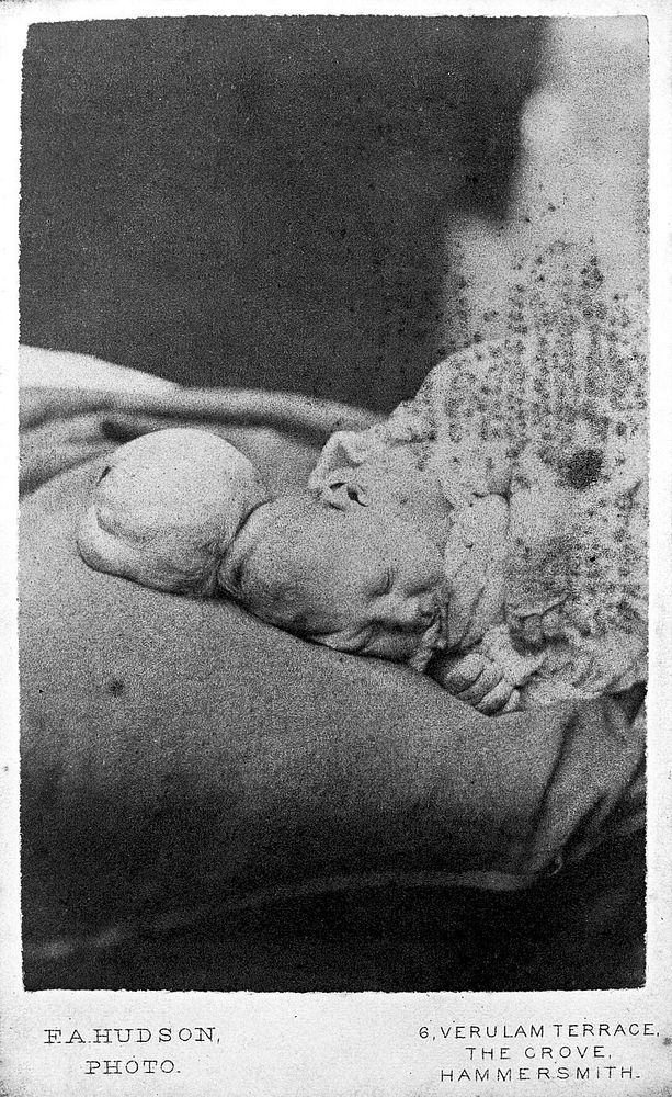 A baby with an encephalocele lying on a bed. Photographs by F.A. Hudson, 1869.