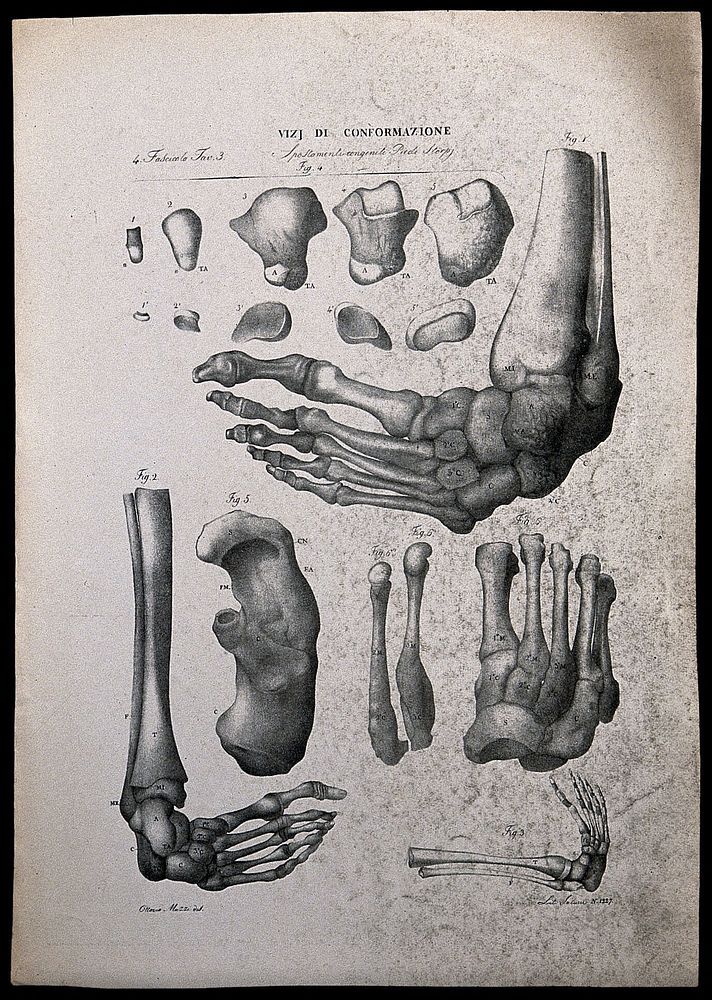 Examples of bone deformities: skeletal detail, numbered for key. Lithograph by Salucci after Ottavio Muzzi, c. 1843.