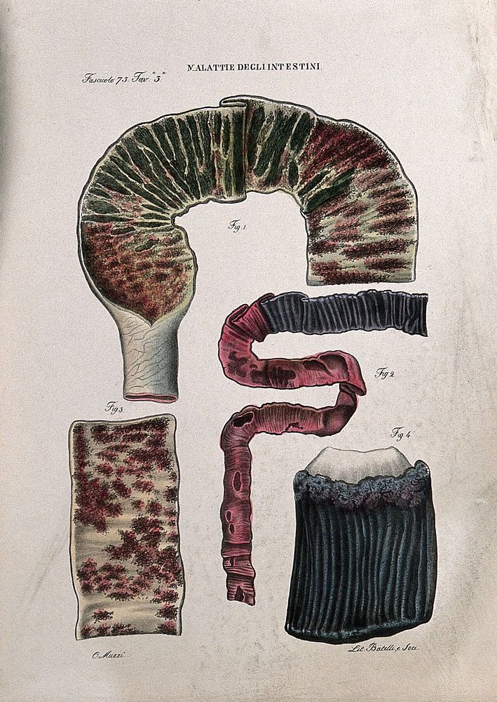 Four sections of diseased intestines, numbered for key. Coloured lithograph by Batelli after Ottavio Muzzi, c. 1843.