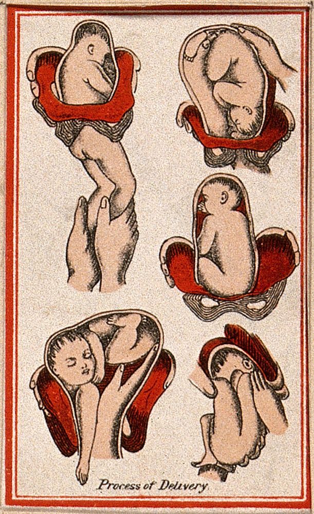 Birth of a baby: five figures, showing the process of delivery. Colour lithograph, 1850/1910.