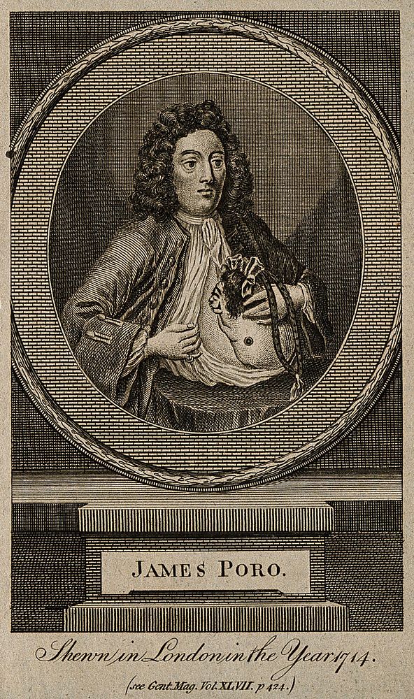 Giacomo Poro, a man with a deformed figure protruding from his chest. Line engraving.