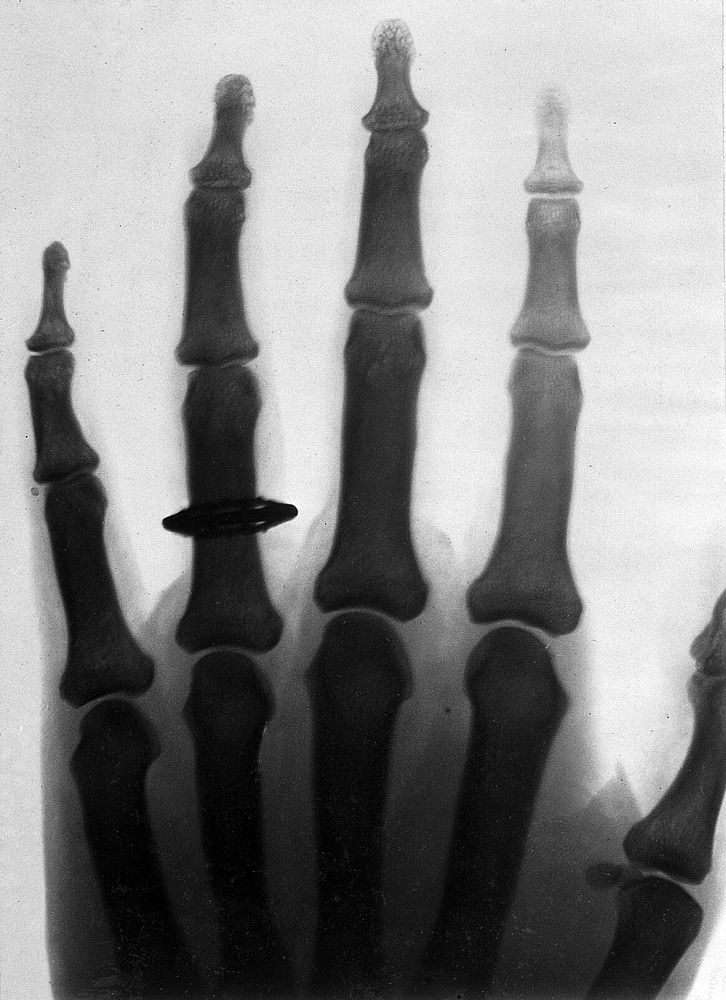 The bones of the human fingers, wearing a finger ring. Photograph of X-ray attributed to L. Ropner, 1897.