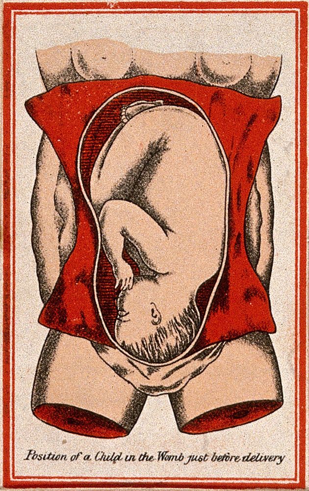 Position of a baby in the uterus, shortly before birth. Colour lithograph, 1850/1910.