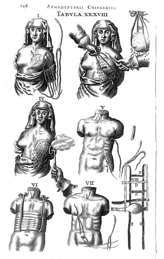 Masectomy, circa 1657