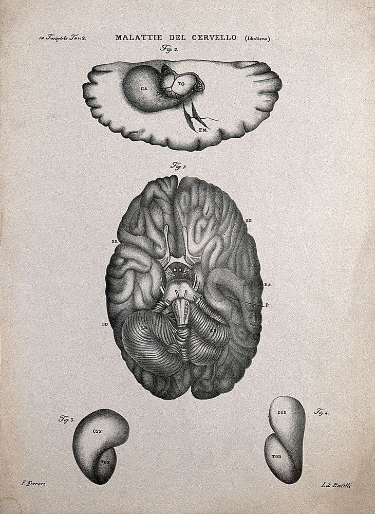Four sections of diseased brain, numbered for key. Lithograph by Batelli after Ferdinando Ferrari, c. 1843.