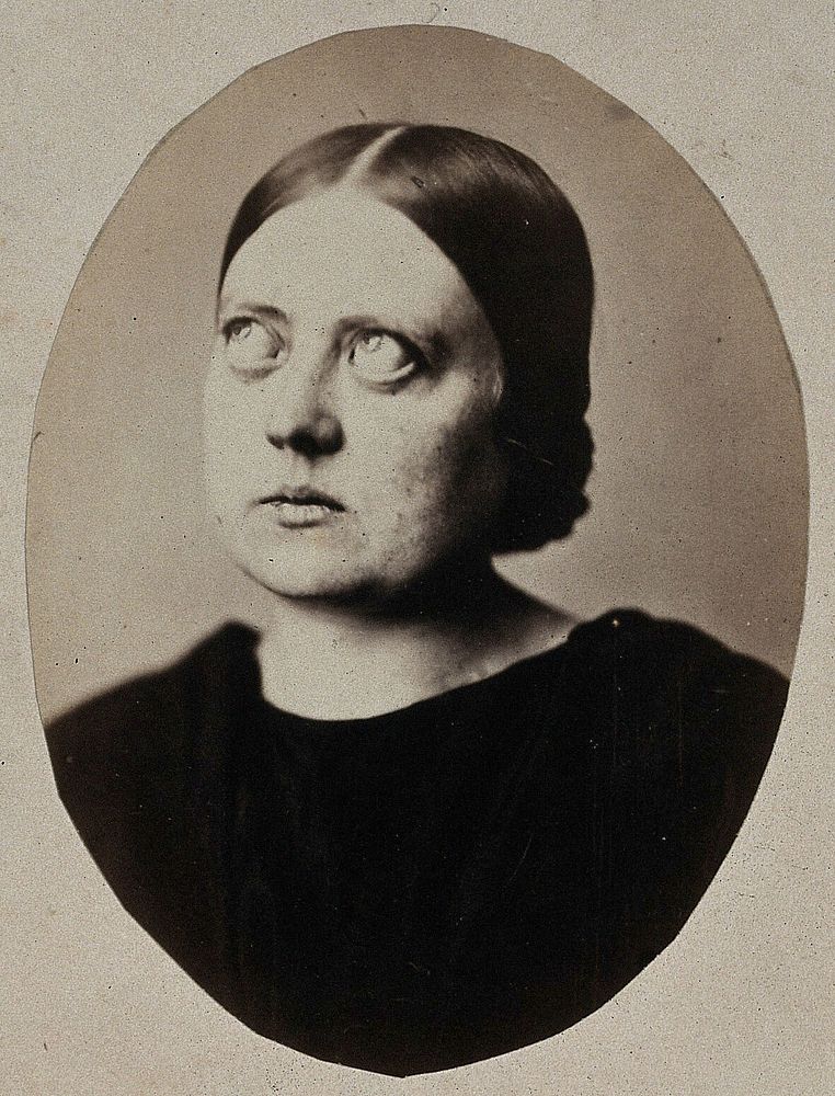 A woman, with bulging eyes, looking upwards. Photograph, 1864.