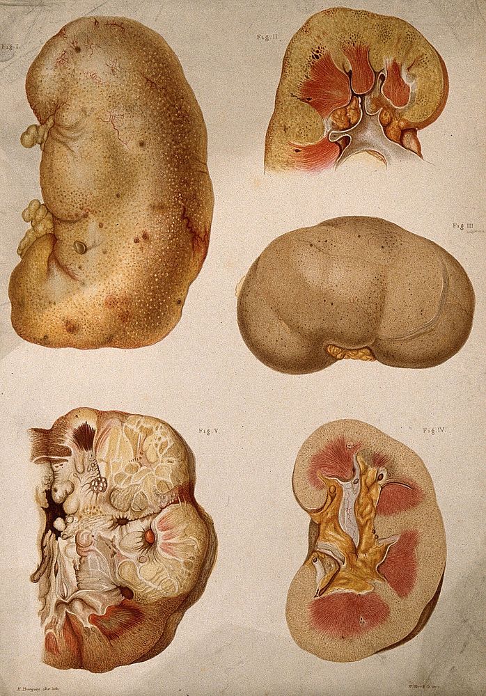 Urinary calculi: fourteen examples. Chromolithograph by West Newman & Co. after L. Aldous, ca. 1888.