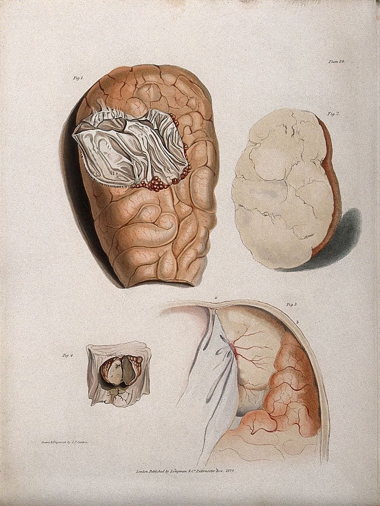 Four sections of diseased brain. Coloured stipple etching by C. J. Canton for Richard Bright, 1829.