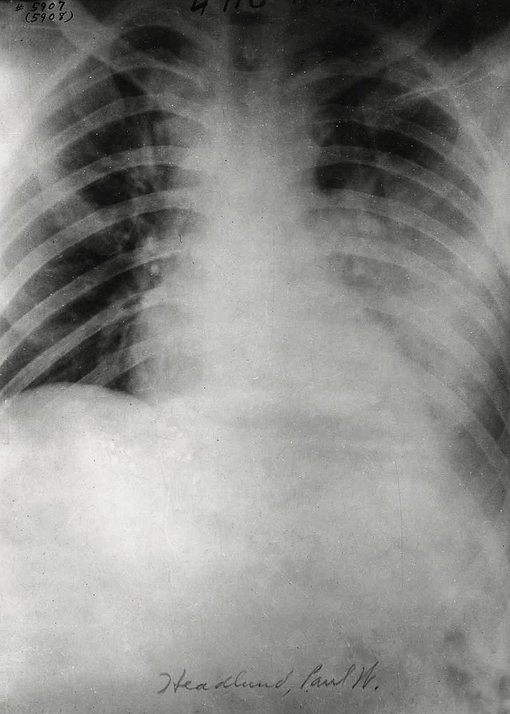 Chest X&ndash;ray of patient with influenza during World War I. Original image from National Museum of Health and Medicine.…