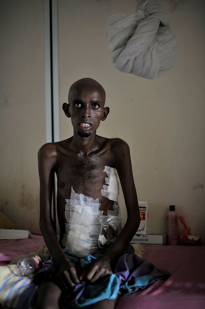 A patient sits in one of Madina Hospital's wards in Mogadishu, Somalia, on February 20. AU UN IST PHOTO / Tobin Jones.…