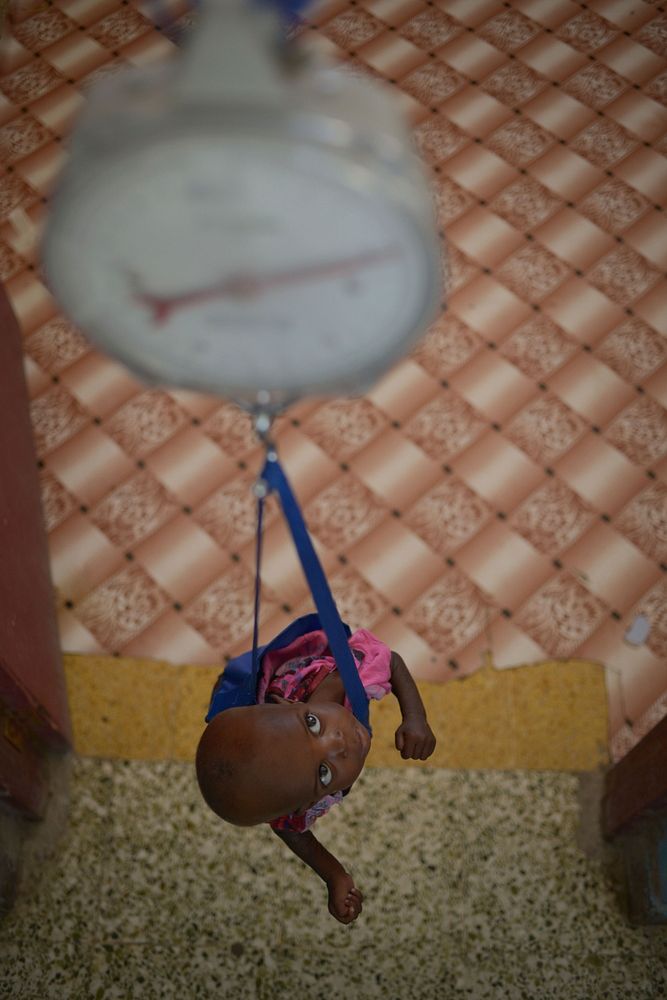 A malnourished child looks up at a scale as he's weighed and treated for malnourishment at Banadir hospital in Mogadishu…