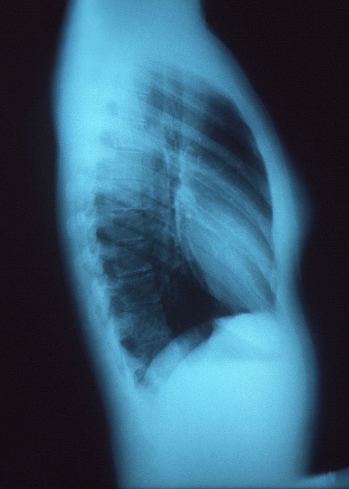 A right lateral chest x-ray of normal, healthy thoracic and pulmonary conditions. Original image sourced from US Government…