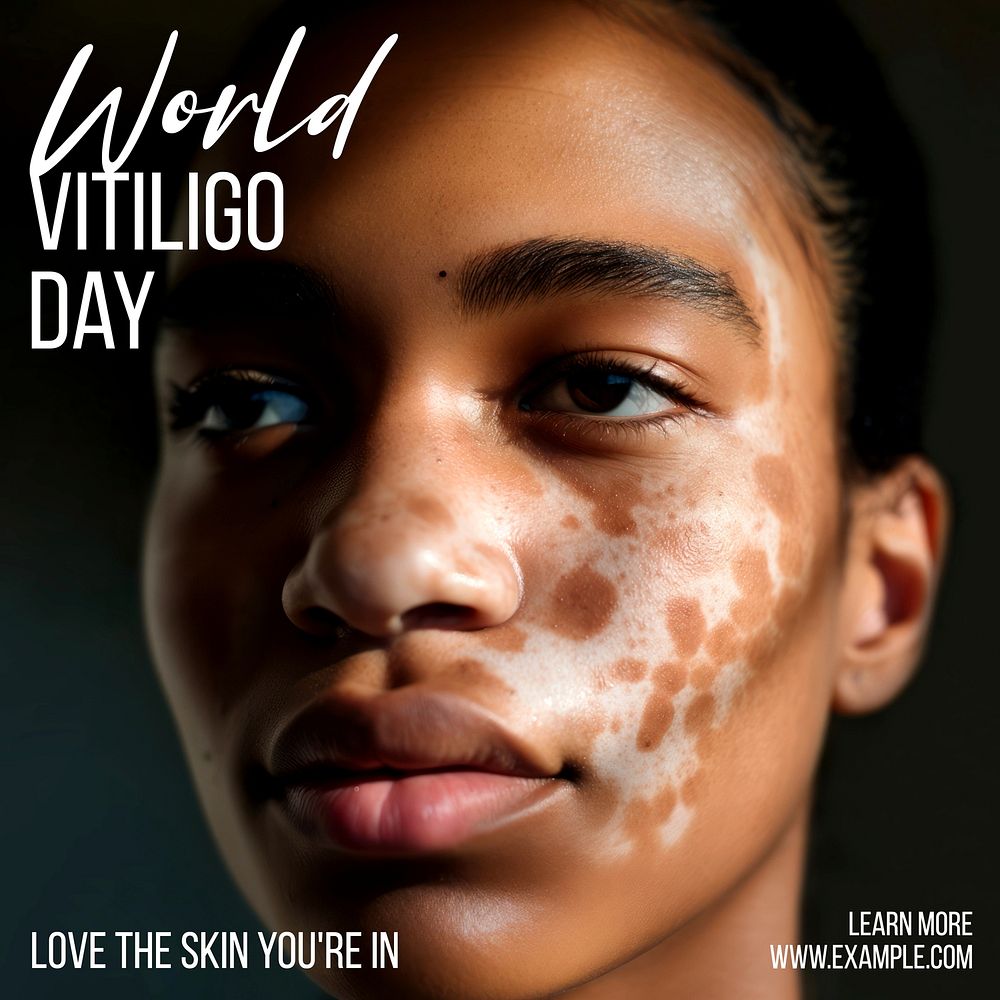 World vitiligo day Instagram post template
